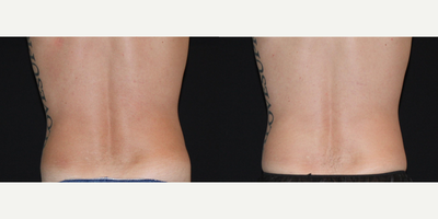 CoolSculpting before and after photo