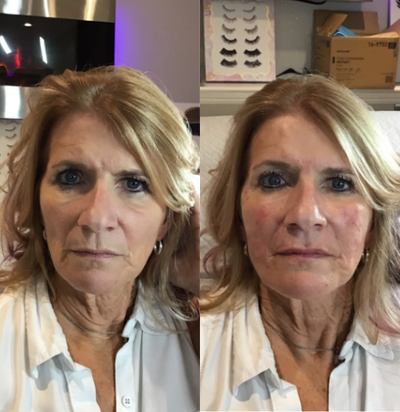 Dysport before and after photo