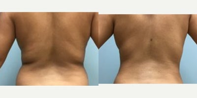 Liposuction before and after photo