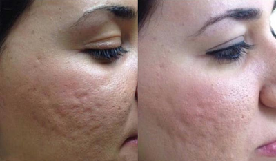 Microneedling before and after photo