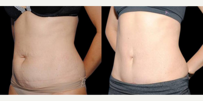 Mini Tummy Tuck before and after photo