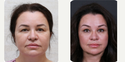 Brow Lift before and after photo