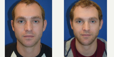 Chin Implant before and after photo