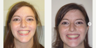 Invisalign before and after photo