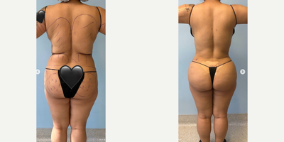 Liposuction before and after photo