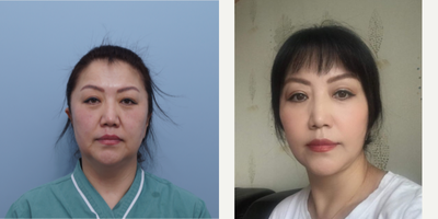 SMAS Facelift before and after photo