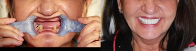Smile Makeover before and after photo