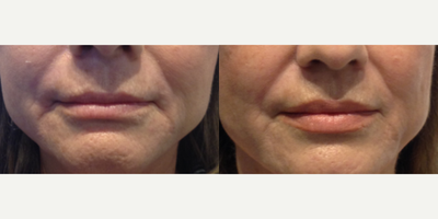 Bellafill before and after photo