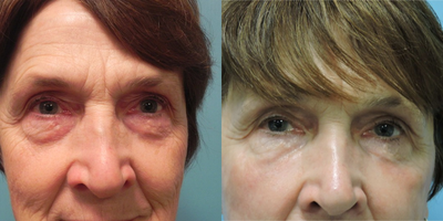 CO2 Laser before and after photo