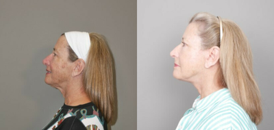 Deep Plane Facelift before and after photo