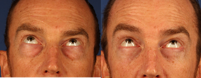 Eyelid Surgery before and after photo