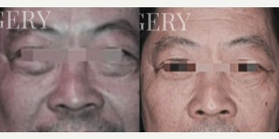 Eyelid Surgery before and after photo