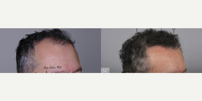 Hair Transplant before and after photo