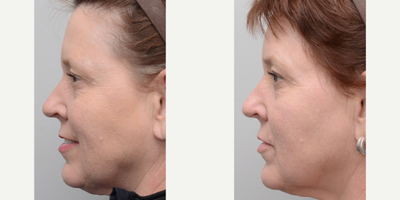 Laser Resurfacing before and after photo