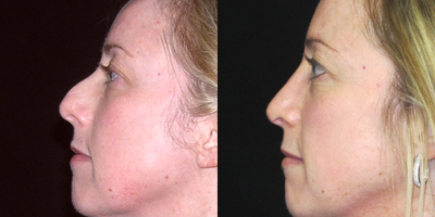Rhinoplasty before and after photo