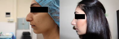 Rhinoplasty before and after photo