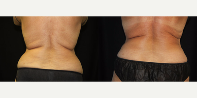CoolSculpting before and after photo