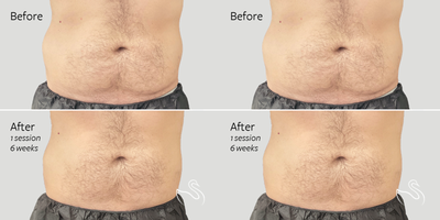 CoolSculpting before and after photo
