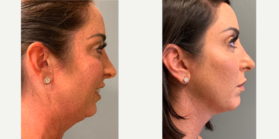 Deep Plane Facelift before and after photo
