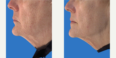 Exilis before and after photo