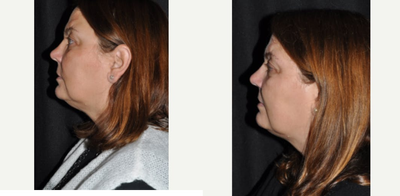 Kybella before and after photo