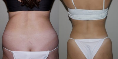 Liposuction before and after photo