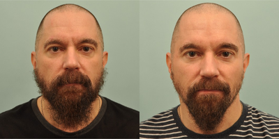 Liquid Facelift before and after photo