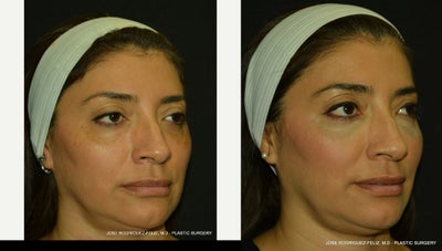 Radiesse before and after photo