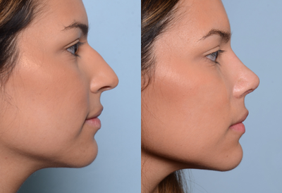 Rhinoplasty before and after photo