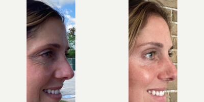 Botox before and after photo