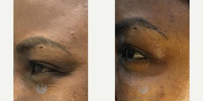 Botox before and after photo
