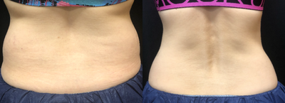 CoolSculpting before and after photo