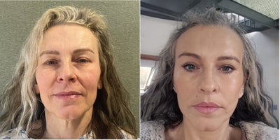 Facelift before and after photo
