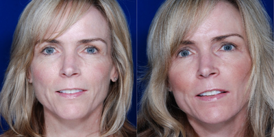 Facial Fat Transfer before and after photo