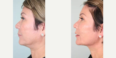 Radiesse before and after photo