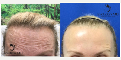 Dysport before and after photo