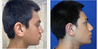 Ear Surgery before and after photo