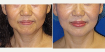 Liposculpture before and after photo