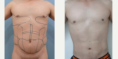 Liposuction before and after photo
