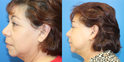 PrecisionTx before and after photo