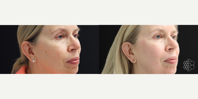 Halo Laser before and after photo