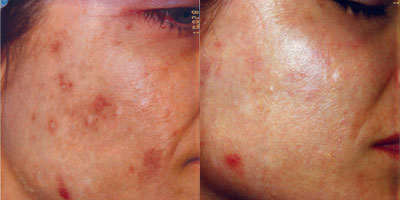 IPL before and after photo