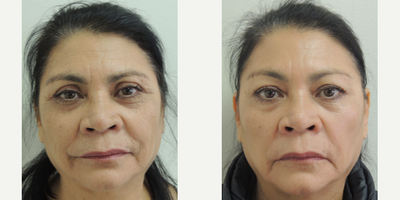 Juvederm before and after photo