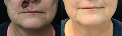 Mohs Surgery before and after photo