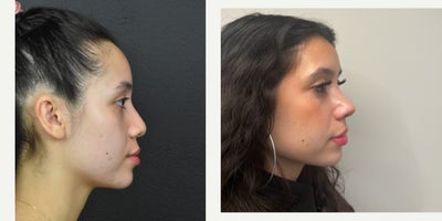 Rhinoplasty before and after photo
