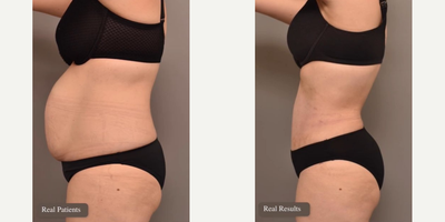Tummy Tuck before and after photo