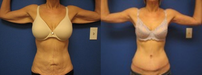 Arm Lift before and after photo