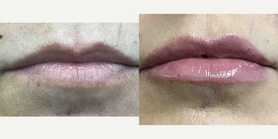 Restylane Refyne before and after photo