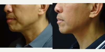 Ultherapy before and after photo