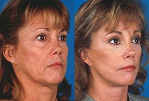 Facelift before and after photo
